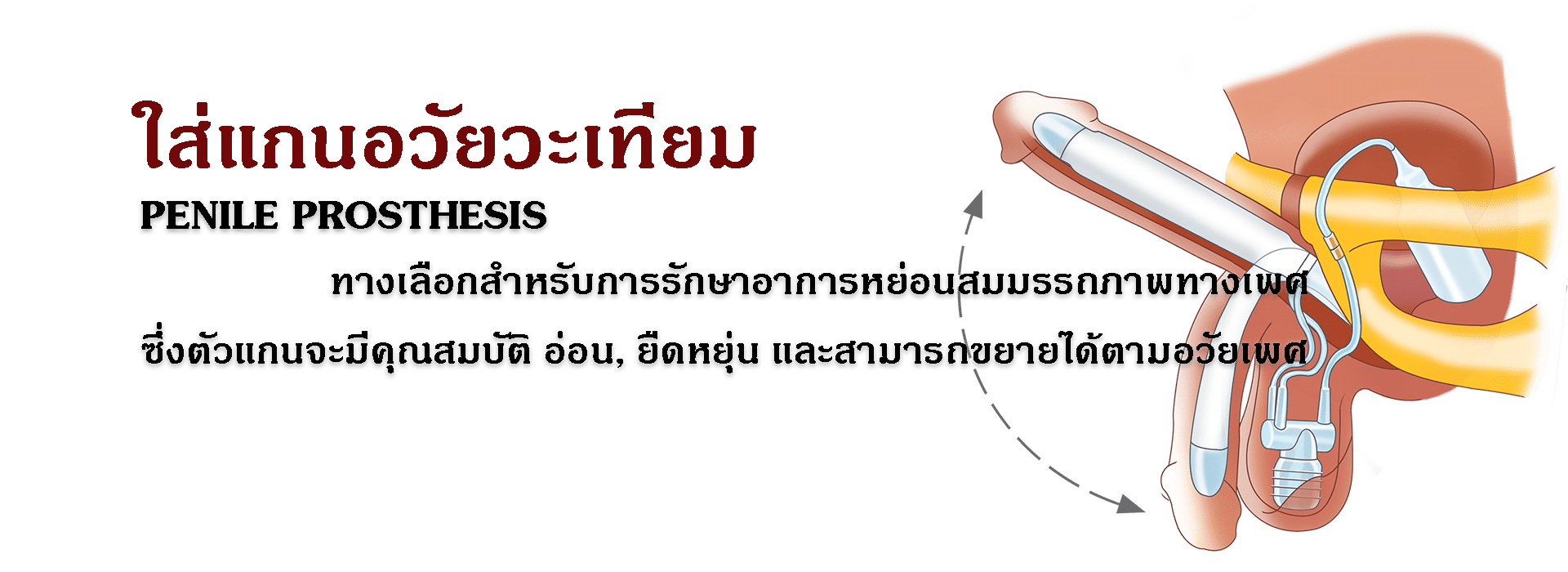 เเกนองคชาต แกนองคชาตเทียม ประเภทของแกนองคชาตเทียม